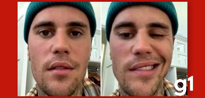 Síndrome de Ramsay Hunt: o que é a infecção que teria paralisado metade do rosto de Justin Bieber