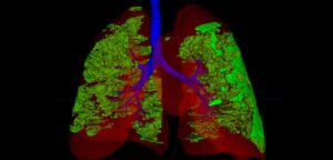 CEPID BRAINN - Divulgacao materia G1 inteligencia artificial danos COVID aos pulmoes