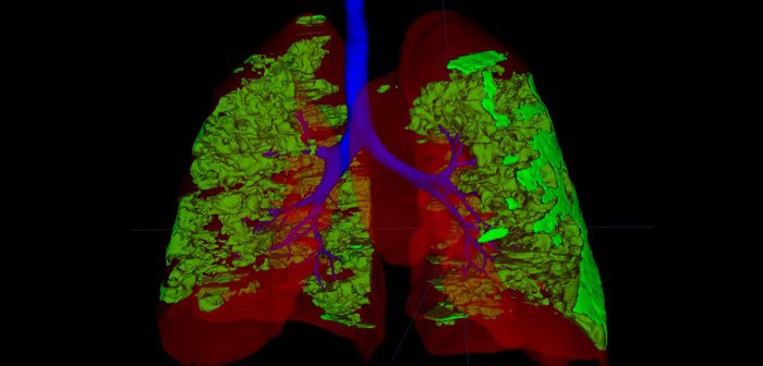 CEPID BRAINN - Divulgacao materia G1 inteligencia artificial danos COVID aos pulmoes